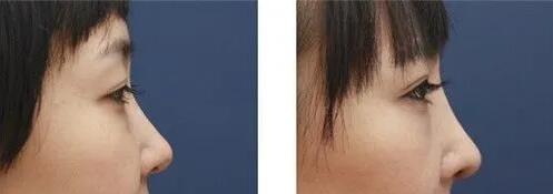 八大处王欢鼻综合案例_疤痕体质可以做耳软骨鼻综合吗