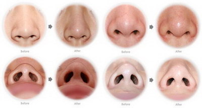 耳软骨隆鼻后鼻头硬多久变软_耳软骨隆鼻鼻头多久可以变软