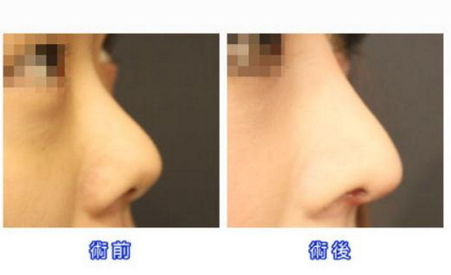 鼻假体取出后鼻梁恢复_鼻假体取出后鼻梁变化