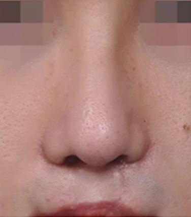 鼻中隔矫正手术后塞鼻子多久_鼻中隔矫正手术后有疤痕吗