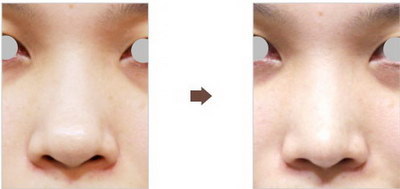 鼻翼缩小的正确方法图解_鼻翼缩小要多久可以恢复