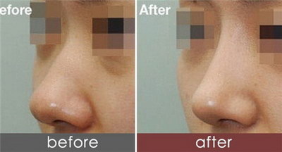 鼻头鼻翼缩小手术方法_鼻头鼻翼缩小手术恢复期