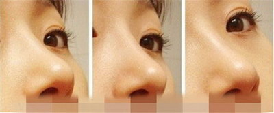 鼻子整形多久恢复正常_鼻子整形了会有影响吗