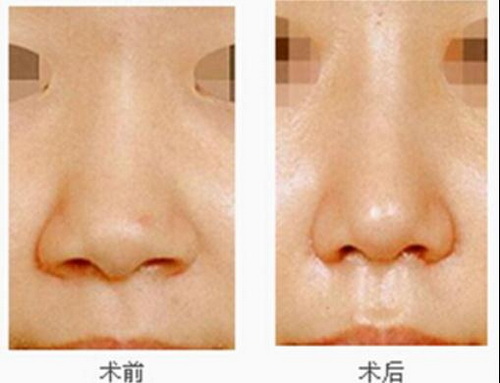 玻尿酸填充鼻基底效果对比_玻尿酸填充鼻基底效果对比图