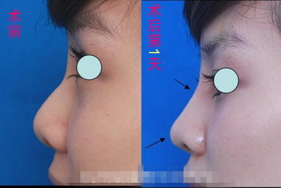 鼻综合眼综合可以吃山药么_鼻综合眼综合一起几天恢复