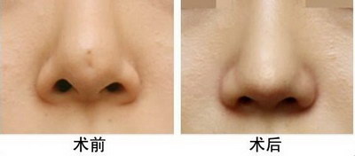 鼻小柱缺损再造_鼻尖鼻小柱缺损修复不宜采用的方法是