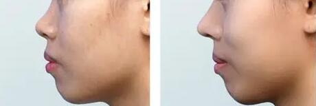 玻尿酸打鼻子多久能戴眼镜_玻尿酸打鼻子一般注射多少