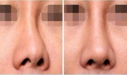 鼻子缩小手术亲身经历_鼻子缩小手术恢复过程