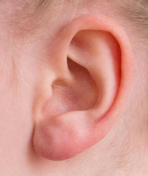 耳朵上长疙瘩是淋巴肿瘤吗_耳朵上长疙瘩是哪里不好