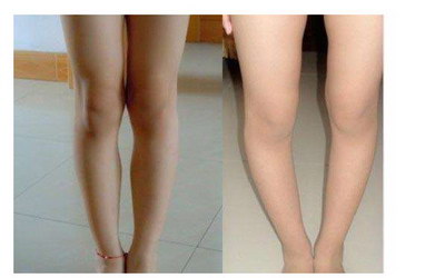 o型腿脂肪填充的危害_o型腿脂肪填充多久能恢复
