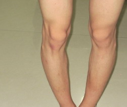 o型腿矫正手术的危害_o型腿矫正手术后遗症