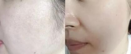 北京协和医院皮肤美容科哪个专家好_北京协和医院皮肤美容科祛斑