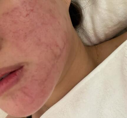 脸颊两侧出痘痘的原因(为什么脸颊两侧会出现痘痘？)