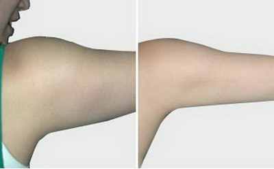 吸手臂脂肪要多久恢复_吸脂手臂的危害有哪些