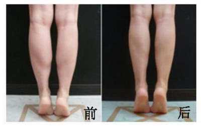 腿部发胖的原因【腿部发胖会长紫色条纹吗】