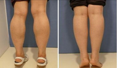 大腿抽脂减肥视频_大腿抽脂减肥几天能看出效果