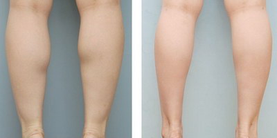 大腿抽脂几个月才能恢复正常_大腿抽脂局麻能不能忍受