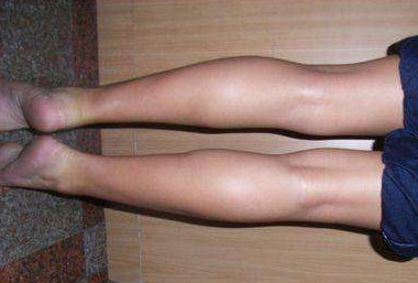 大腿抽脂多长时间能恢复好(大腿抽脂需要恢复多长时间)