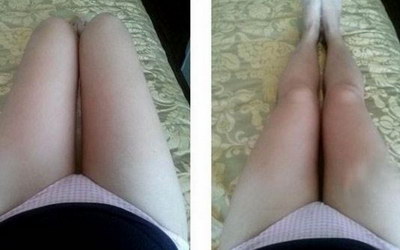 大腿抽脂后多久可以正常下蹲(大腿抽脂后多久可以恢复正常饮食)
