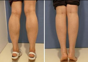 大腿抽脂后发紫怎么办_大腿抽脂的恢复期