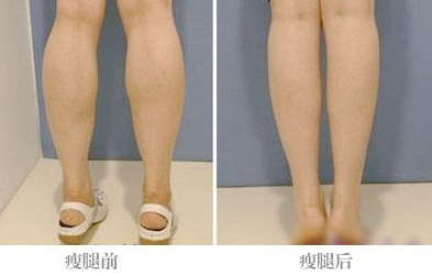 大腿吸脂术后要穿几个月塑身衣_大腿吸脂术后要穿多久的塑身衣