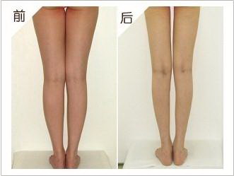 大腿吸脂穿多久塑形裤_大腿吸脂要穿多久的塑形裤