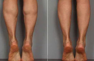 大腿抽脂多久能走路(大腿抽脂术后需要多久恢复？)