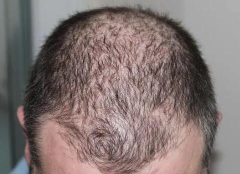 中年脱发是什么病_中药能治疗脱发吗