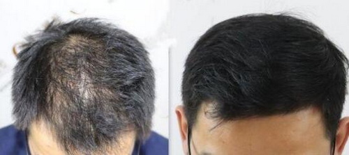 脂溢性皮炎脱发最佳治疗方案_脂溢性脱发的原因及治疗方法