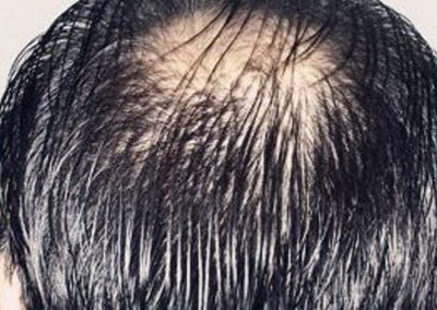 植发能治好遗传性脱发吗