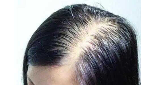 生发防脱发的中药有哪些_预防脱发的方法