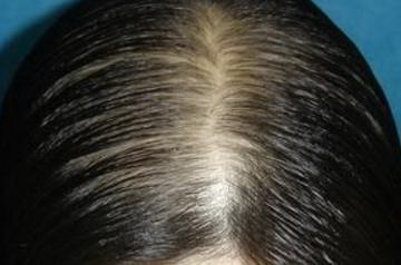 脱发是什么科室_脱发是什么情况导致的