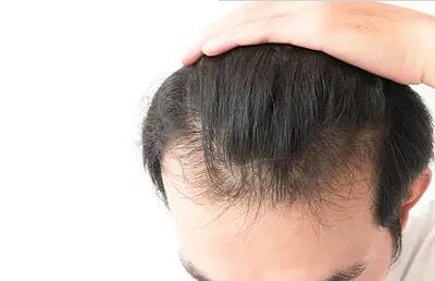 吃维生素几可以防脱发_吃什么可以防脱发掉发
