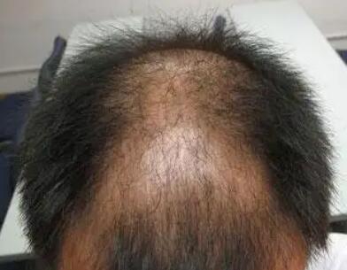 治疗生发脱发的好方法(生发激光帽治疗脱发)