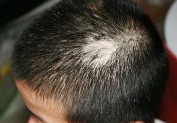脂溢性脱发的原因有哪些[造成脂溢性脱发的原因有哪些]