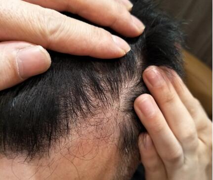 扬州市治疗脱发去哪里最好(治疗脱发，你可以去哪里寻求较好的效果？)