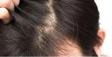 吃什么药可以治疗脱发白发_吃维生素a可以防止脱发吗