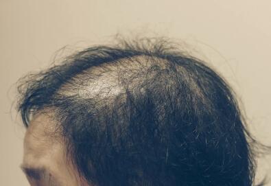吕洗发水哪款是防脱发的_吃什么维生素可以预防脱发