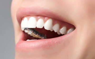 带牙套期间牙齿掉了怎么办_带牙套期间牙齿发黄
