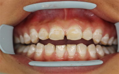 刷牙方式不正确导致牙龈萎缩