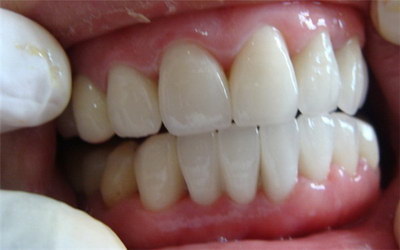 牙齿矫正上牙和下牙合不到一起(牙齿矫正上牙和下牙合不到一起)