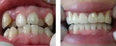 牙齿有黑线医生说不用补_牙齿有黄渍怎么样用什么方法可以去除