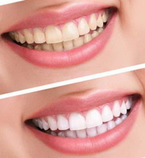 单颗牙缺失两边有牙齿怎么补_发现什么的牙齿可以自动修复