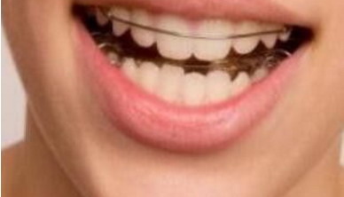 做完牙贴面牙线进不去牙缝_做完牙贴面龅牙可以修复吗