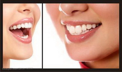 拔牙之后多久可以正常刷牙_拔牙之后多久可以正常说话