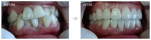 3岁儿童牙齿磕凹进去一点_40岁牙齿酸软是怎么回事