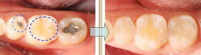 拔牙后牙内侧涩是怎么回事_拔牙后牙旁边的肉红肿