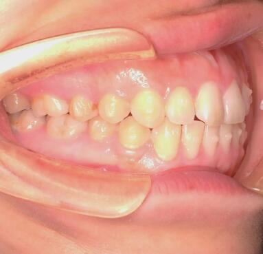 补牙是看牙体牙髓科吗(补牙是挂牙体牙髓科吗)