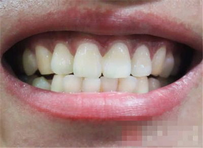 牙肉萎缩是什么原因导致
