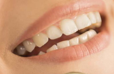 全口树脂牙的使用方法_取掉树脂牙贴面后牙齿是什么样子